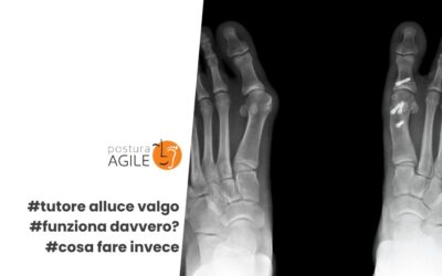 Tutore per alluce valgo: perché non funziona (e cosa fare invece)