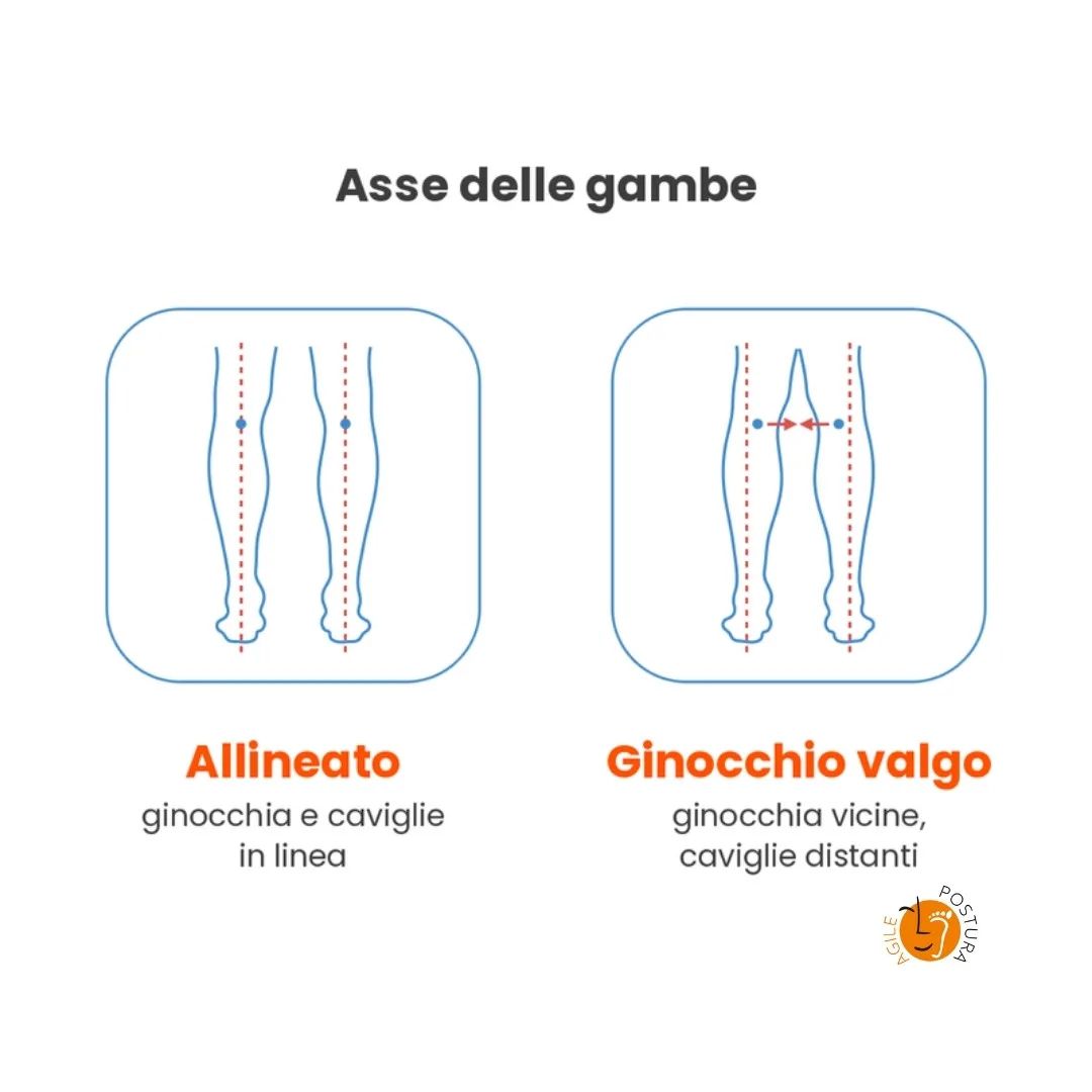Asse delle gambe: allineato e ginocchio valgo, con le ginocchia vicine e le caviglie distanti